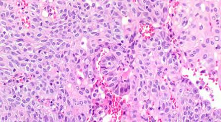 nuclear features of papillary carcinoma 1 point each = 3; 2