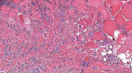Thyroid Papillary Carcinoma: Histologic Types Usual or Conventional types Occult, incidental, microcarcinoma, microscopic Follicular variant Encapsulated variant Macrofollicular variant Oncocytic or