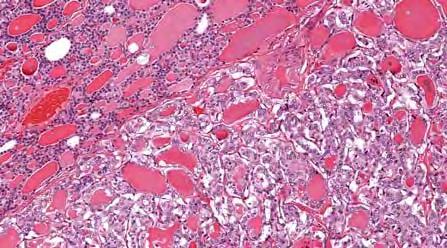 Noninvasive Follicular Thyroid Neoplasm with Papillary-like Nuclei Absent