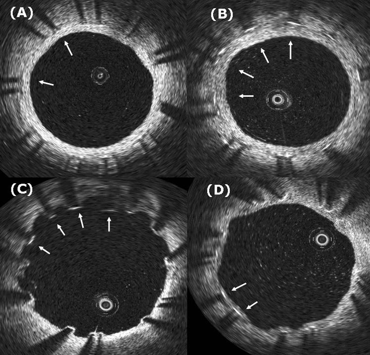 Figure 1 Representative optical coherence tomography images of zotarolimus-eluting stents (ZES) and sirolimus-eluting stents (SES).