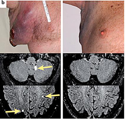 Treatment of metastatic melanoma with Tumorinfiltrating