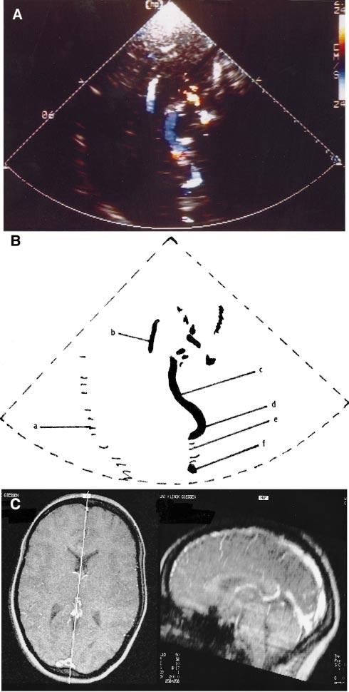 Stolz et al April 1999 817 Figure 4. A, Contrast-enhanced TCCS using the PMFBW showing the ICV, vein of Galen, and parts of the pericallosal artery and the straight sinus.