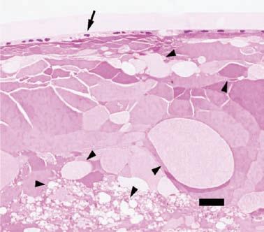 Hypertrophy of epithelial cells (arrows) and degenerative lesions such as vacuolation of lens fiber and morgagnian globules (arrow heads) were seen in SDT fatty rats from 8 weeks of age and in SDT