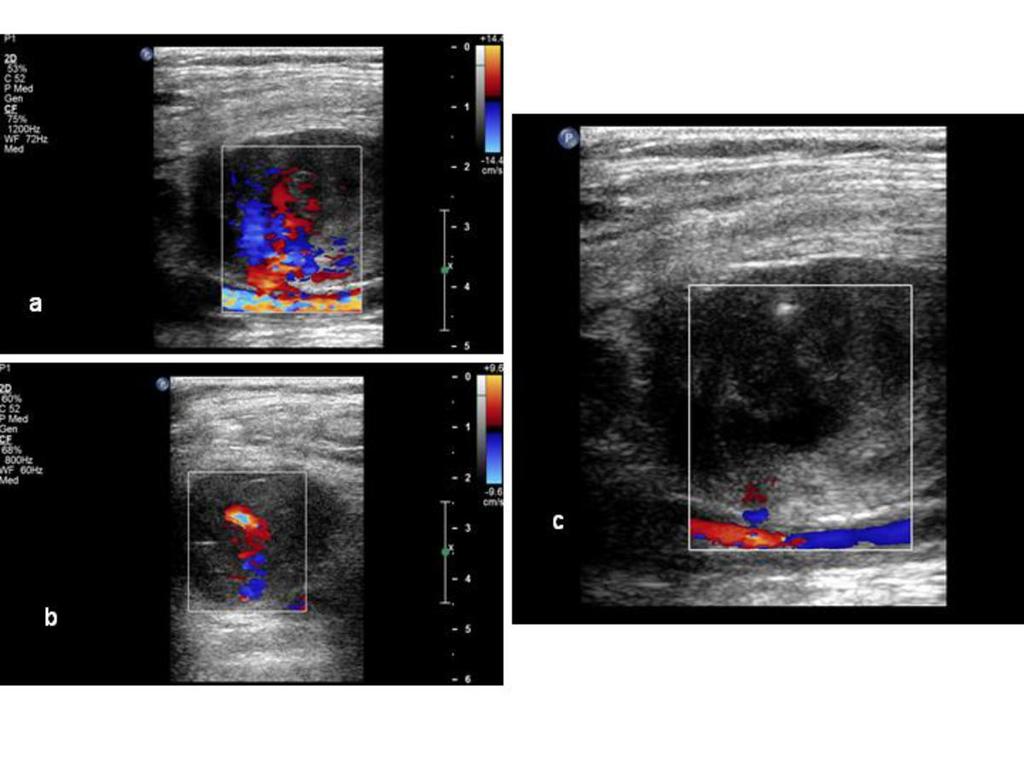 Fig. 5: a,b) Colour Doppler US image obtained in a 78-year-old man demonstrates a simple pseudoaneurysm with a short neck originating from the superficial femoral