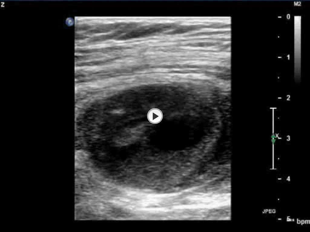Fig. 3: Thrombin injection into a simple pseudoaneurysm.