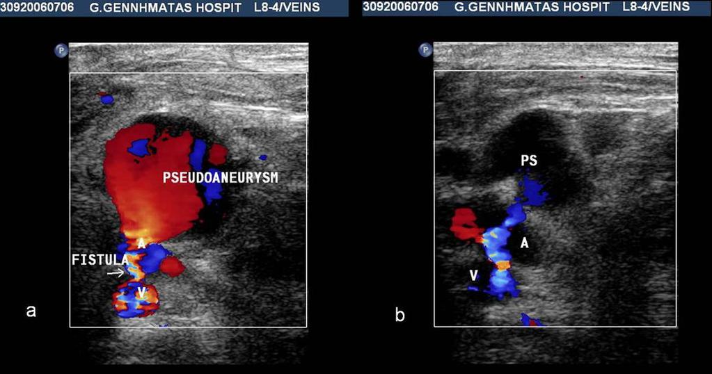 Fig. 2: Longitudinal colour Doppler US image obtained in a 61-year-old man demonstrates a simple pseudoaneurysm with a long neck (40mm)(arrow).