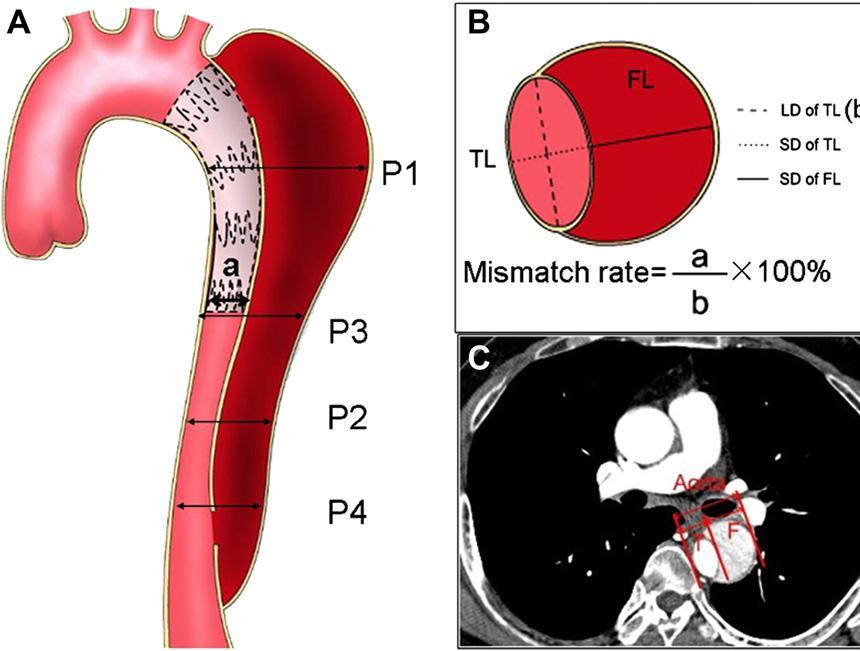 Remodelling of the aorta after TEVAR+RBS 465