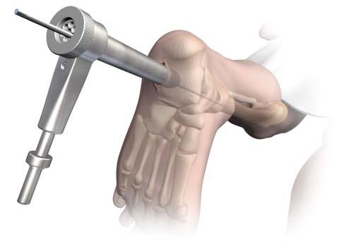 The use of provisional guide pin fixation to maintain correct position of the respective arthrodesis is recommended.