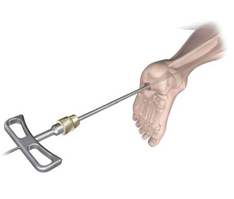 Reducing the Fracture In most cases, the 3.0 mm x 600 mm Ball Tip Guide Rod can now be easily inserted through the initial portal made by the Entry Reamer and placed into the center of the tibia.