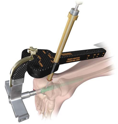 Screw Insertion Although screw placement sequence is at the surgeon s discretion, it is recommended that the locking screws be placed sequentially from calcaneus to tibia to allow impaction at each