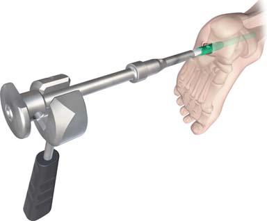 Thread the Large Nail Extractor tool into the distal end of the nail before screw removal to restrict nail movement.