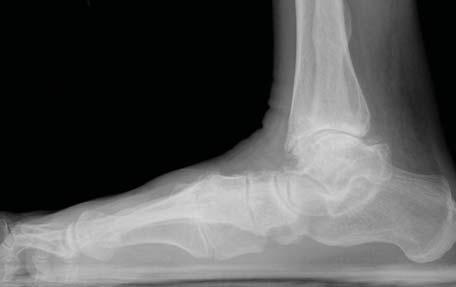 Design Rationale The TRIGEN Hindfoot Fusion Nail (HFN) brings the simplified instrumentation of the TRIGEN Nail System to the hindfoot.