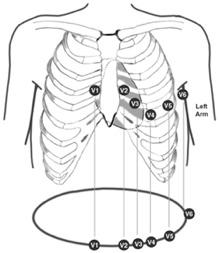 2 Leads EKG: Views of Heart Limb leads no view: avr