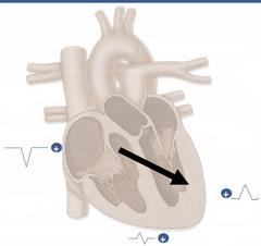 If the vector is toward the electrode, the wave registered on EKG is up, if away from the electrode, the wave is