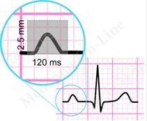 EKG at Rest: P wave P wave= atrial depolarization Amplitude of P wave <