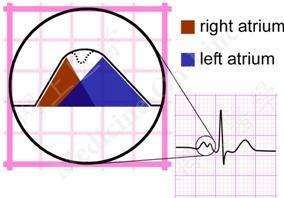 5 small squares); Duration of the P wave < 120 ms Since right atrium