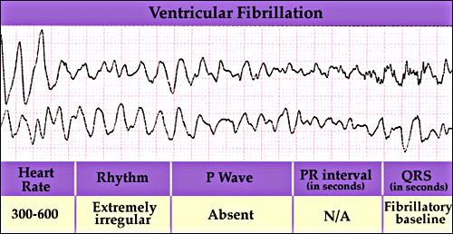 Ventricular Fibrillation http://medlib.