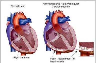 Arrhythmogenic right ventricular dysplasia (ARVD) Right ventricular free wall replaced by fat or fibrosis Left ventricle is typically sparred Arrhythmias may be the first symptom, including SCD EKG: