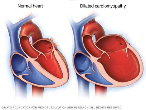 Dilated cardiomyopathy (DCM) Dilatation and impaired contraction of one or both ventricles -As the heart muscle begins to stretch, the chambers enlarge, the walls become thinner and weaker, losing