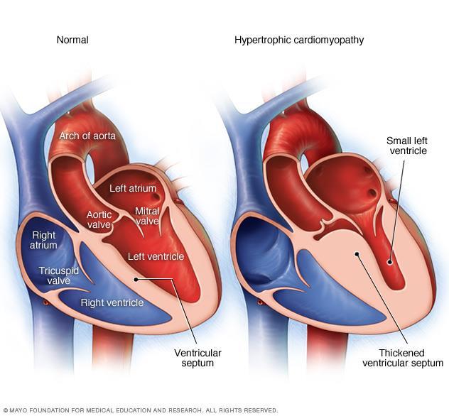 Hypertrophic Cardiomyopathy (HCM/HOCM) Myocardial cells enlarge leading to thickened walls The size of the ventricle typically becomes smaller Occurs in different patterns As the myocardium thickens