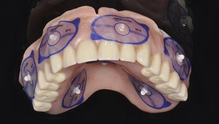 If there is metal in the patient s existing denture: a.
