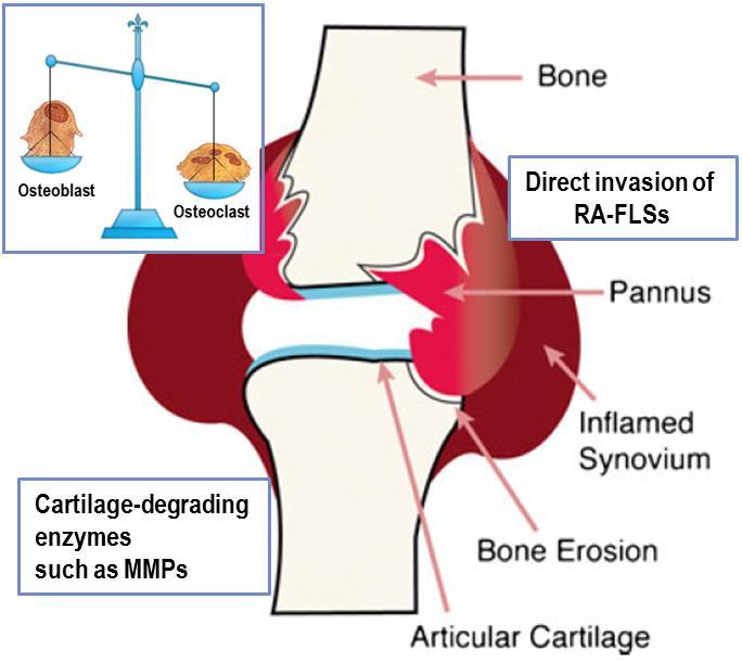 Disturbed joint tissue repair & remodeling in RA Erosion of periarticular bone, the typical feature