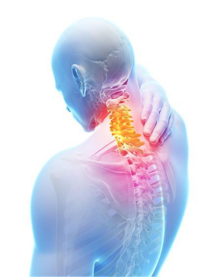 HF-10 Upper Extremity and Neck Pain : ENZA-ULN Trial Ongoing study for treatment of UE and Neck pain with Nevro HF-10 therapy Neck timulation is typically very difficult with traditional C