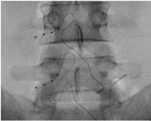timulation Fine electrodes with 4 contacts are threaded via the epidural space part way through the intervertebral foramen and allowed to lie up against the sensory dorsal root