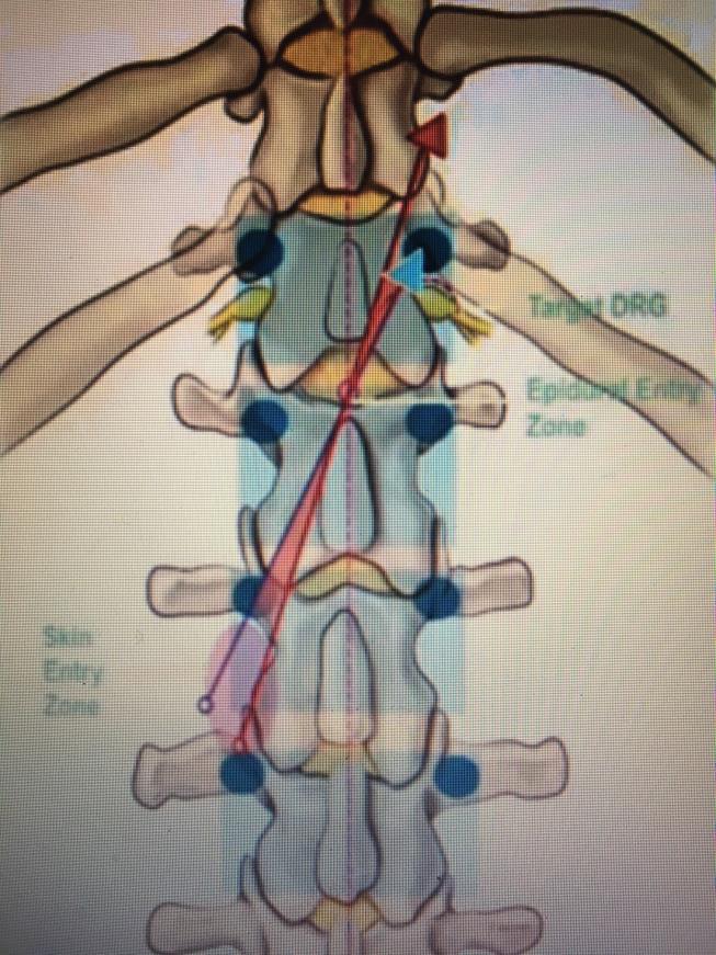 timulation Technique: kin entry 2 to 3 pedicles below the desired target DRG on the contralateral side.