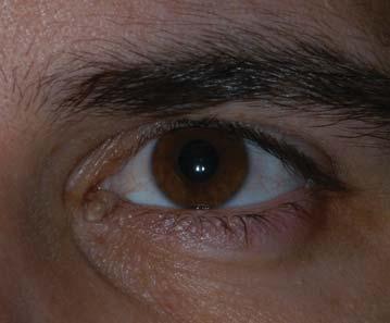 Basal cell carcinoma Most common eyelid malignancy best malignancy