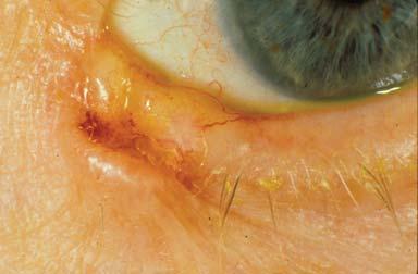 Little blood vessels Types of eyelid malignancies Basal cell