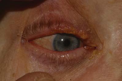 Melanoma Less than 1% of eyelid tumors Has