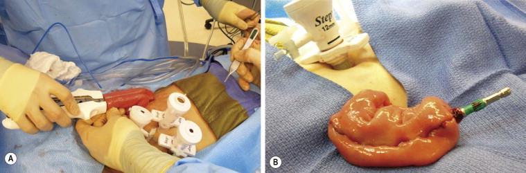laparoscopic proctocolectomy with creation of J-pouch and stapled ileoanal anastomosis.