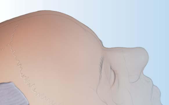 Cranios Reinforced Rotary Mix is an injectable option suitable for bony defects positioned at