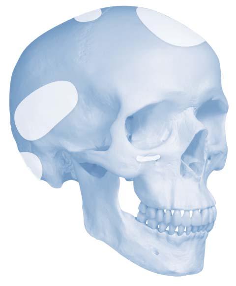 Indications and Contraindications Indications Cranios Reinforced Rotary Mix is indicated for repairing or filling cranial defects and craniotomy cuts with a surface area no larger than 25 cm 2.