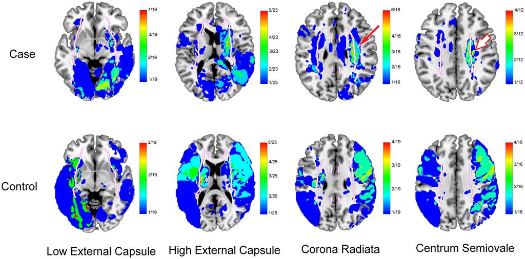 Lim et al Neural Substrates of Poststroke Dementia 1071 Image Preprocessing and Cumulative Lesion Maps To generate cumulative lesion maps, we used the custom-written software Imaging software for