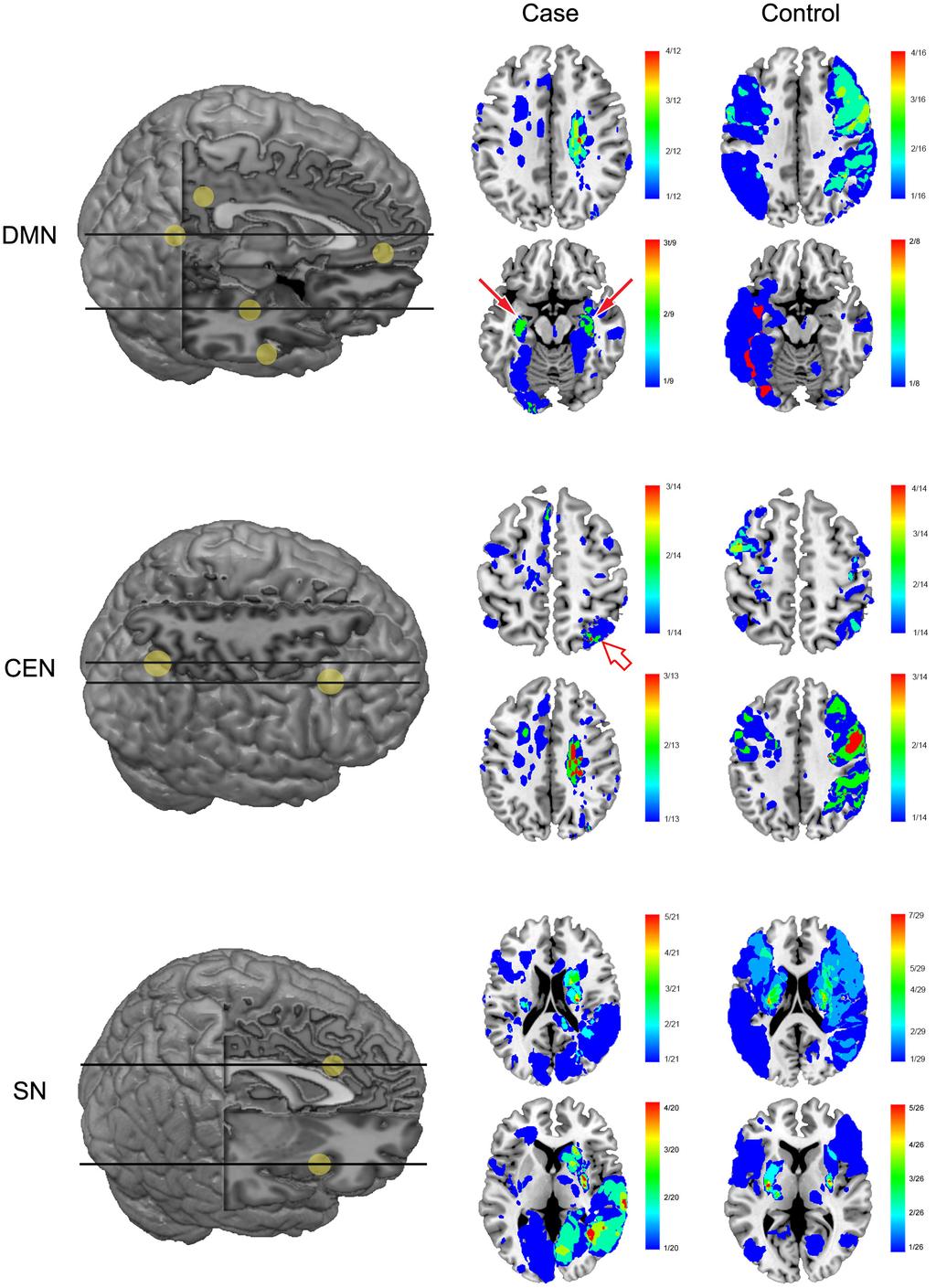 1072 Stroke April 2014 Figure 3. Cumulative lesion maps for cortical hub regions.