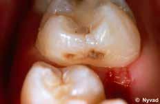 Edwin Kidd Ole Fejerskov Bente Nyvd Infected Dentine Revisited Astrct: Dentine ecomes infected s result of cries lesion formtion on root surfces nd when lesions progress following cvittion of enmel