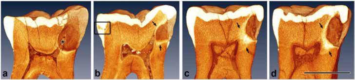 Figure 2. Four consecutive micro-computed tomogrphy scns through deep cries lesion in 2000-yer-old tooth from Imperil Rome.