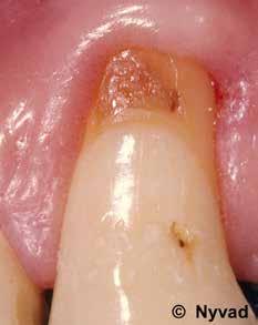In irreversile pulpitis the pin persists for while fter removl of the stimulus, or pin occurs spontneously, nd the pulp is likely to e so dmged tht it must e removed.
