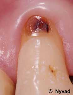 tuules of trnslucent dentine wy nd exposing the vitl odontolsts of sound dentine. We will now consider two circumstnces where infected dentine is present.
