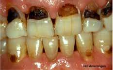 used, the surfce of the lesion looks like culture plte. Finlly, consider the lesions in Figure 5 ( c). Initilly, dentist nd ptient hve concentrted on iofilm control.