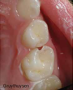 Although the dentist hs produced eutiful restortions, the rel tretment is the iofilm control y the ptient, nd the fct tht the dentine ws infected is totlly irrelevnt!