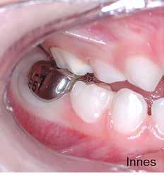 The lesion is ctively progressing nd clening lone will not solve this prolem; restortion is required to id iofilm control nd restore the tooth.