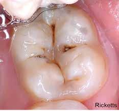 In pst yers the restortive pproch would hve een to excvte the soft dentine thoroughly prior to tooth restortion, the im eing to remove ll the infected dentine.