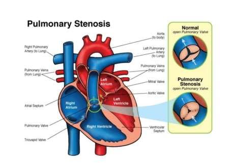What is Pulmonic Stenosis? Pulmonic stenosis (PS) refers to a narrowing of the pulmonic valve (stenosis is the medical term for narrowing).
