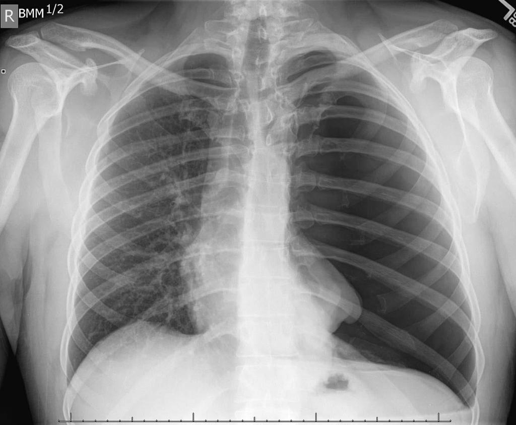 Potential Adverse Events Pneumothorax