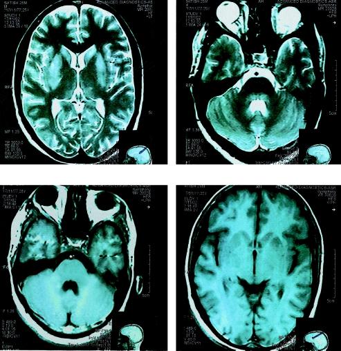 Contd. from page 251 Fig. 2 170 mg/dl). MRI 3-D brain showed hyperintensity lesions in the brain stem and basal ganglia suggestive of encephalitis (fig. 2).