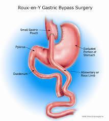 Leak Following Roux-en Y Gastric Bypass, what are the locations of an intestinal