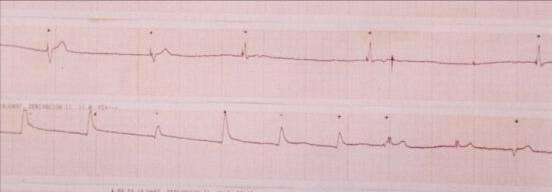 (bradycardia) Pulse absent (CPB) Does not